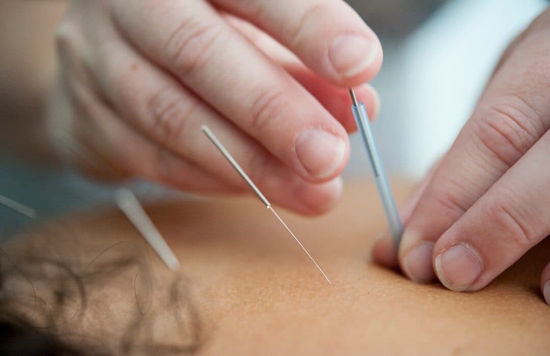 Acupunctuur bij stress en burn-out: wat kun je verwachten in Amsterdam | Alter Physio Amsterdam