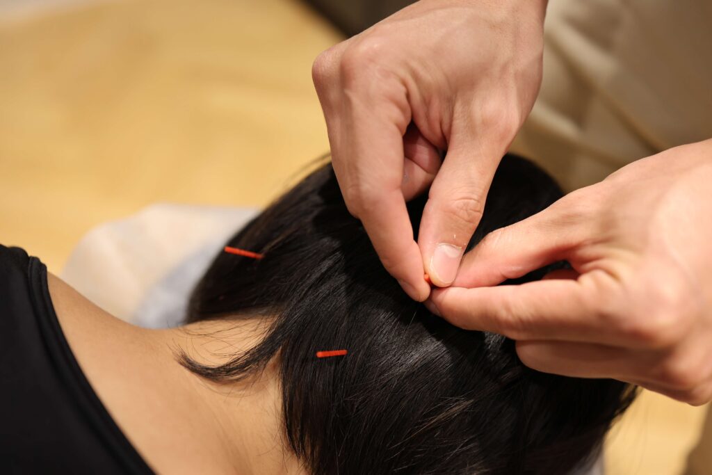 Acupuncture