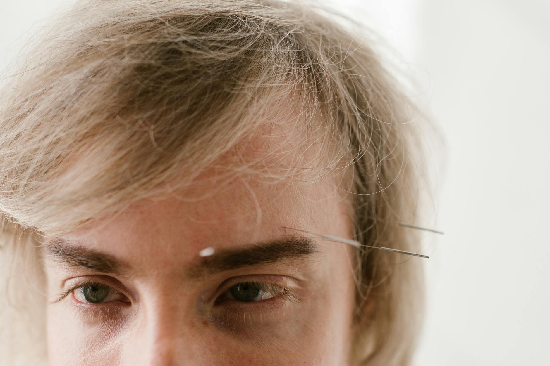 #20 Acupuncture for Stress & Burnout Amsterdam | Alter Physio