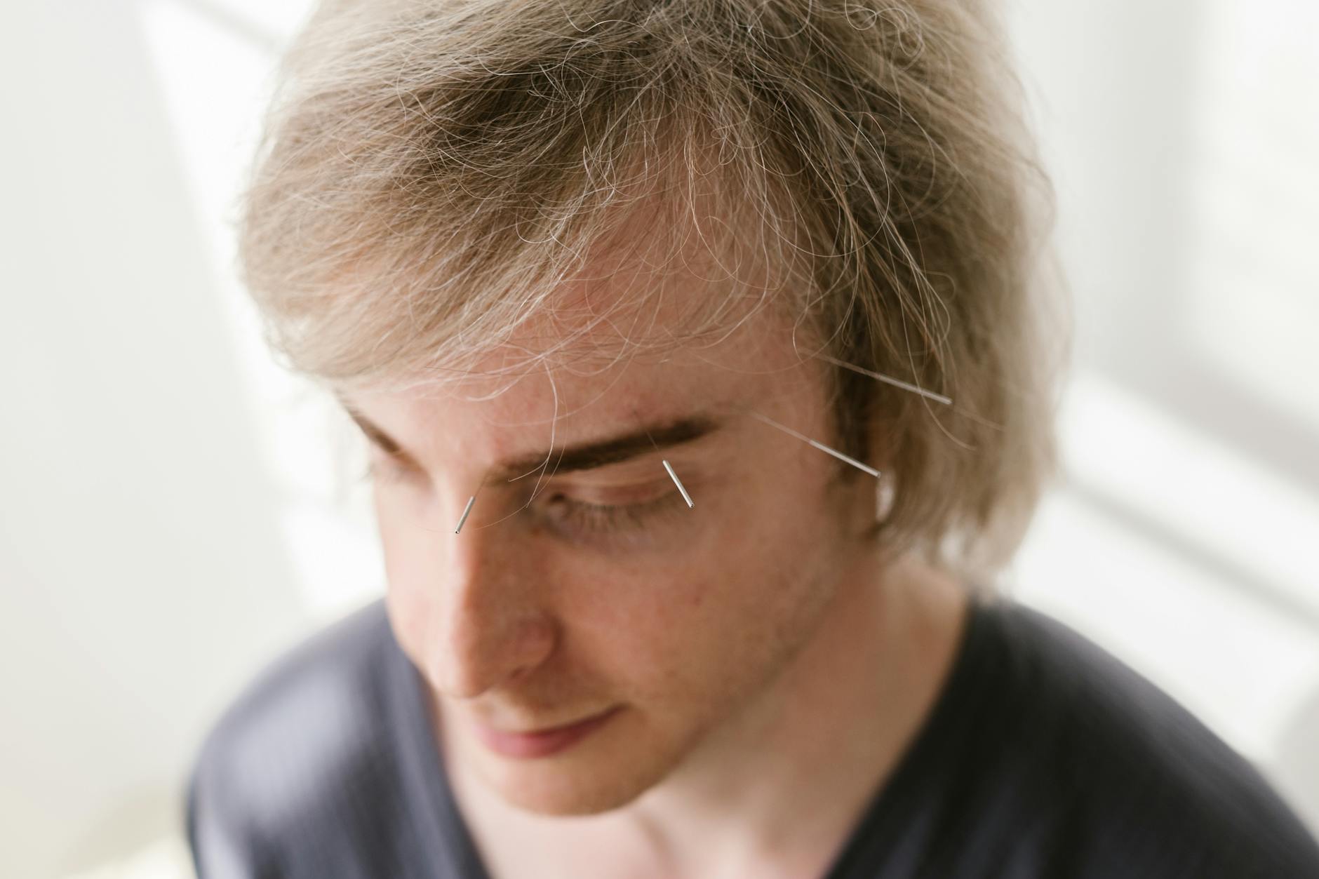 #38 Acupuncture for Hay Fever and Allergies in Amsterdam