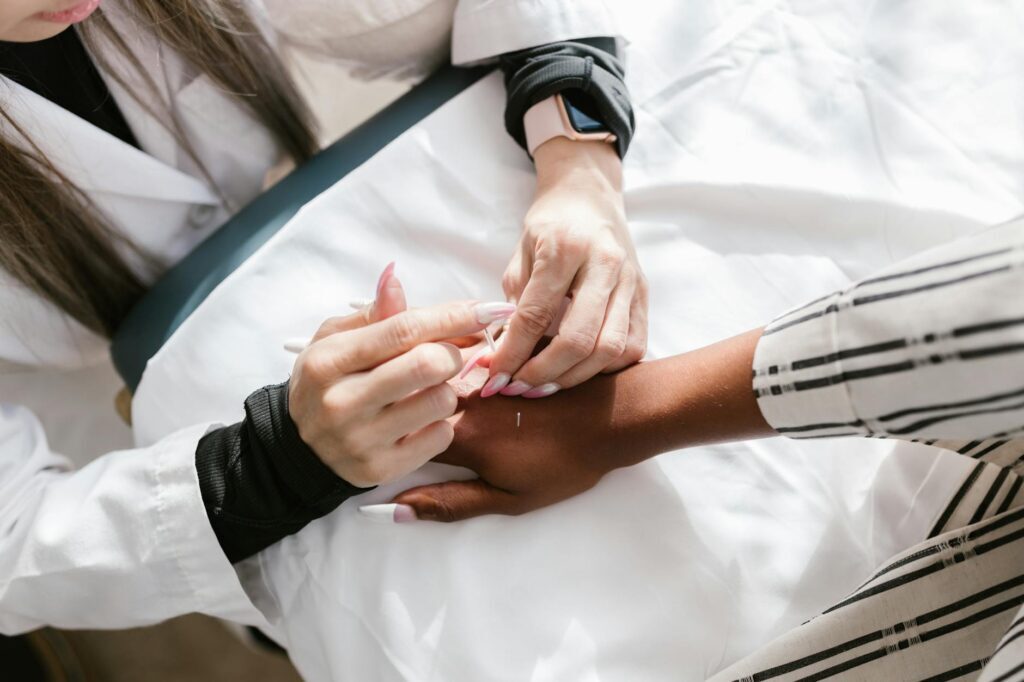 Acupuncture skin treatment on hand for circulation at AlterPhysio Amsterdam