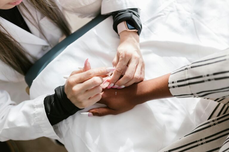 Acupuncture skin treatment on hand for circulation at AlterPhysio Amsterdam
